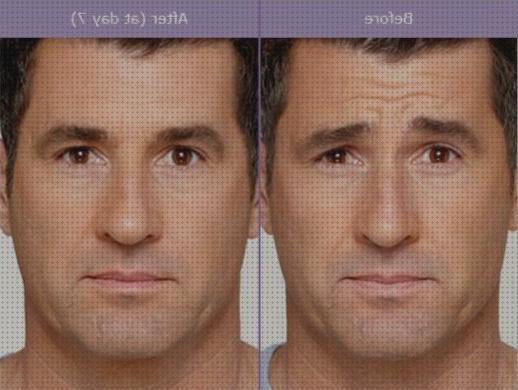 Las mejores hombres botox hombres