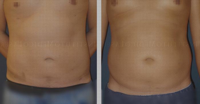 TOP 7 lipolaser de hombres